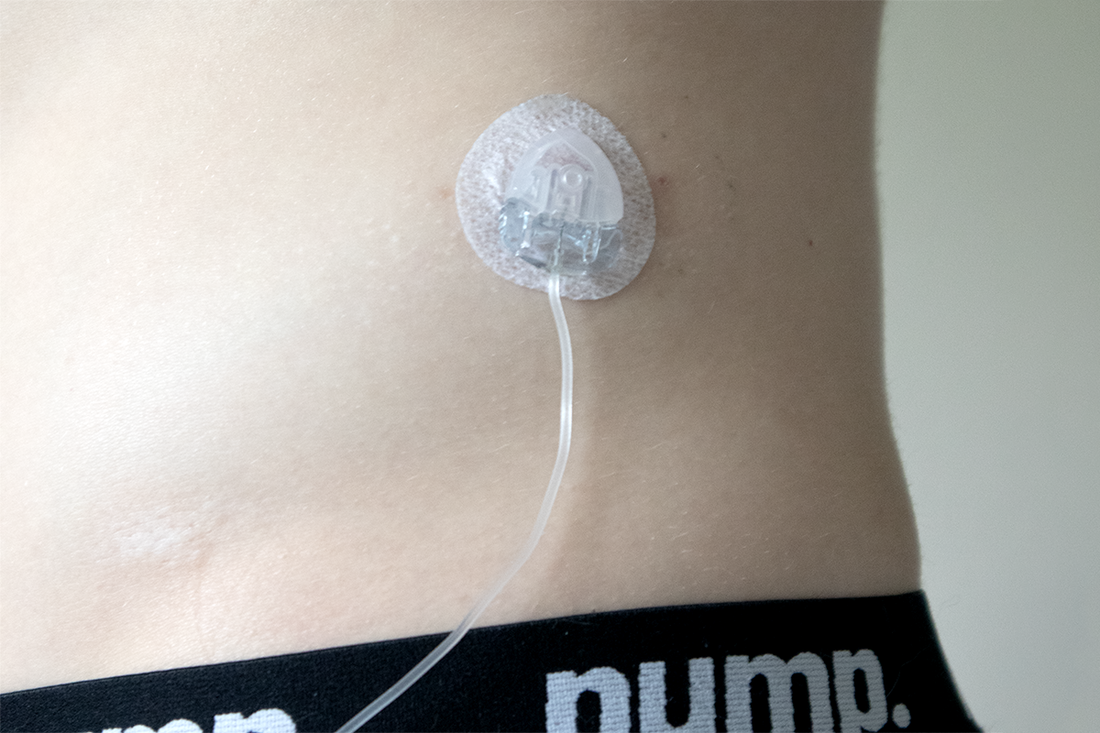 The Significance of Insulin Pump Site Changes